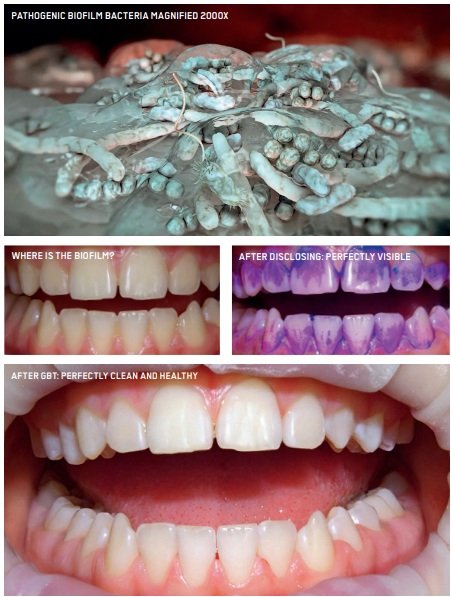 Biofilm removal using Airflow dental treatment